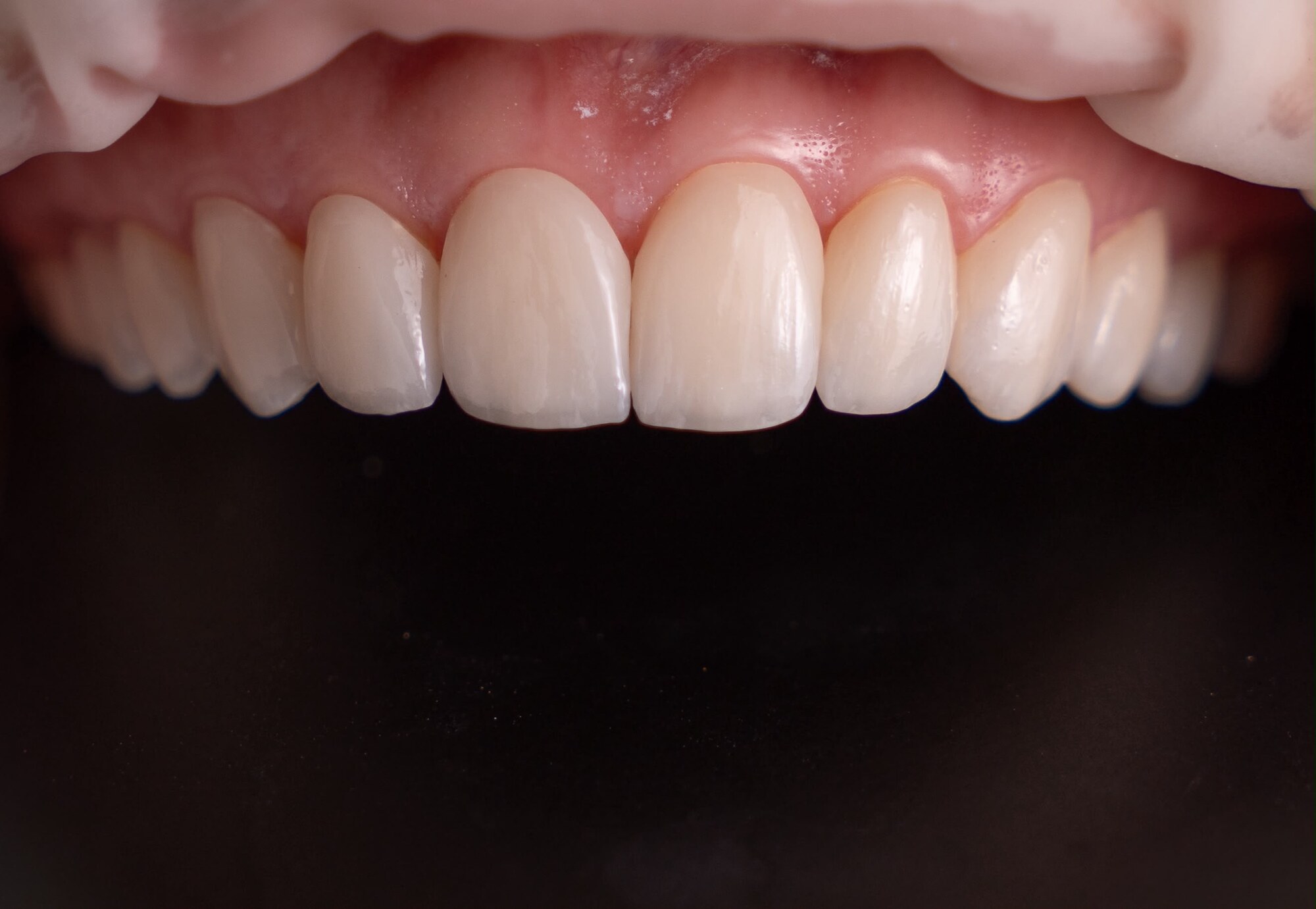 Resultado de rehabilitación estética: sonrisa natural y funcional